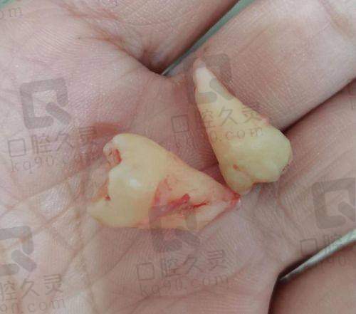 深圳友睦口腔拔下颌正位萌出智齿499元起，微创技术+贴心服务让你告别智齿烦恼