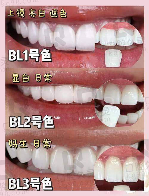 牙齿贴面美白的过程痛苦吗？