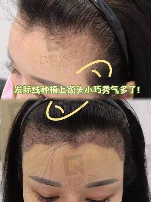 三、福州名韩植发医院口碑如何不妨来看集美们的实例评价