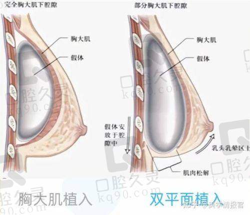 济南艺星杨季涛操刀！免插引流管假体隆胸惊艳来袭，仅38800元起 