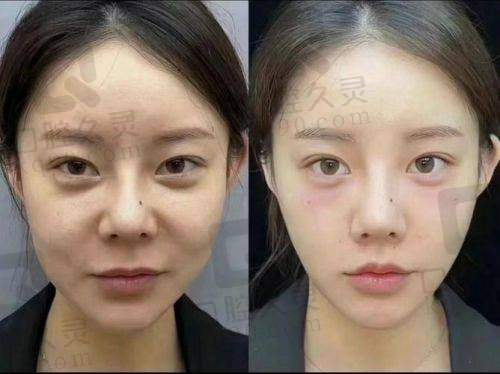 鼻基底填充玻尿酸的过程是怎样的？