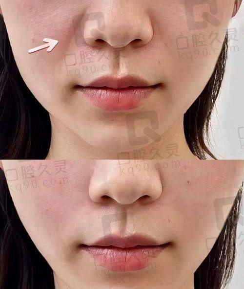 填充后的即时成效和感受