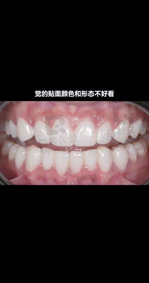 牙齿贴面美白方案是如何制定的？