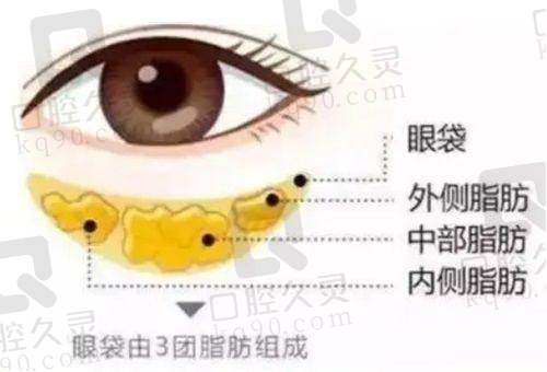 广州中家医家庭医生易普锋的不开刀祛眼袋优势