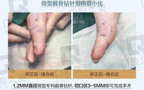 广州中家医家庭医生易普锋提眉术的后续护理建议