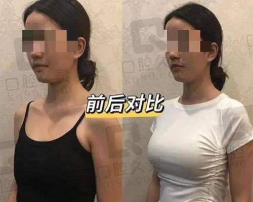 刘月更团队术中术后标准怎么样？精细+安荃一把抓