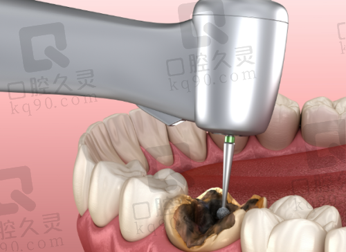 深圳友睦口腔医院牙髓炎根管治疗988元起，李欣等医师用显微技术护你牙健康