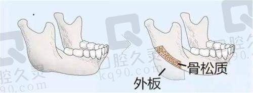 毛面自然型形凝胶乳房假体——CPGTM 321
