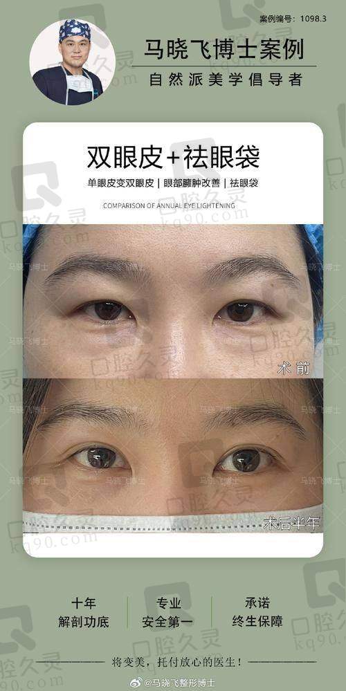 广州中家医家庭医生易普锋医生的眼部综合整形技术