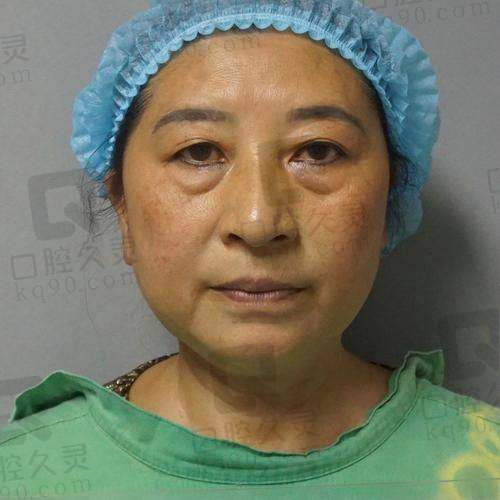 广州中家医家庭医生易普锋外切祛眼袋手术的优势分析