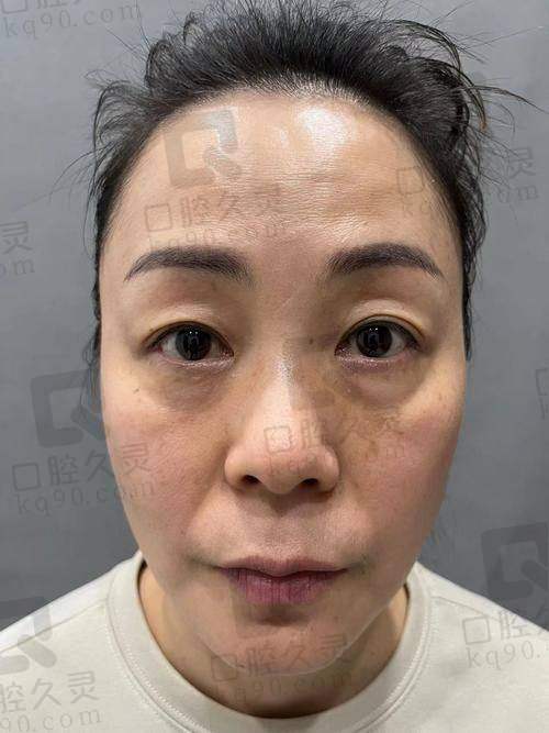 广州中家医家庭医生易普锋外切祛眼袋总结