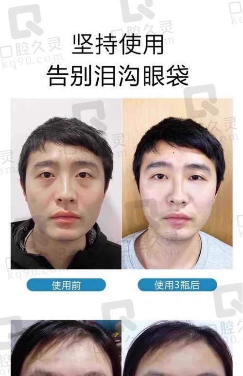 广州中家医家庭医生易普锋不开刀祛眼袋4930元起，术后修复快，几乎无需修复期