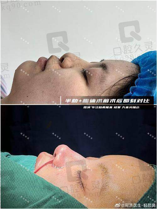 广州中家医家庭医生易普锋射极峰隆鼻13750元起的术后成效