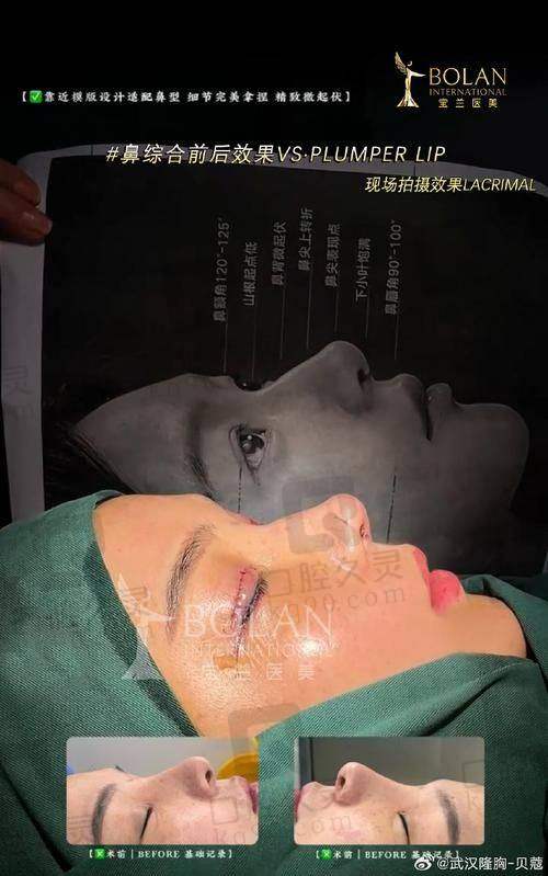 广州中家医家庭医生易普锋射极峰隆鼻13750元起的优势特征