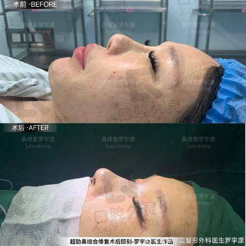 总 结：广州中家医家庭医生易普锋射极峰隆鼻13750元起，理想的选择