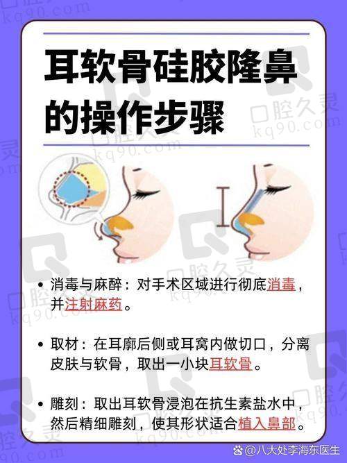广州中家医家庭医生易普锋射极峰隆鼻13750元起的价格分析