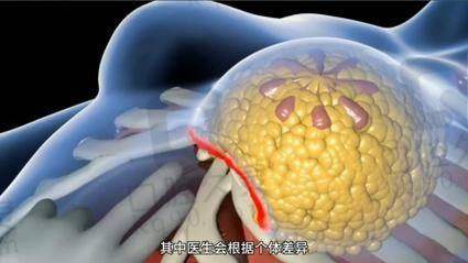 深圳军科刘月更双眼皮失败修复怎么样？黄金0.3mm标准让你翻车变翻身