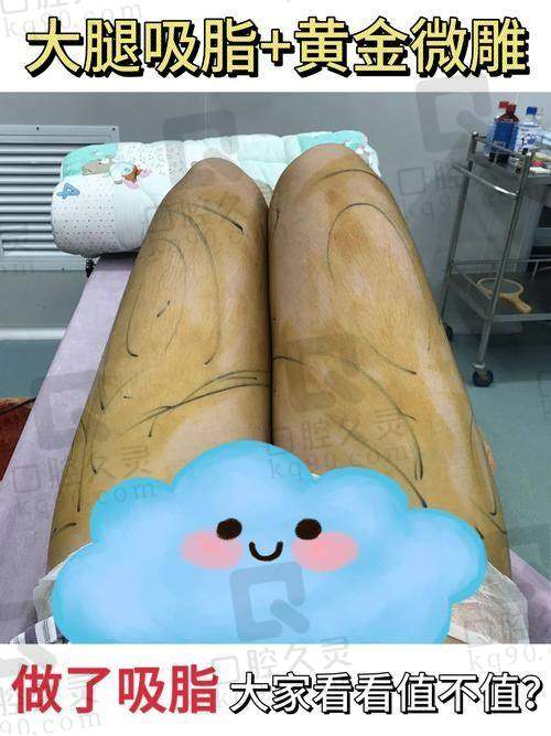 广州中家医家庭医生易普锋水动力小腿吸脂，价格5750元起，能有效去除多余脂肪，塑造优美腿型