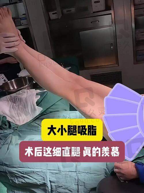 广州中家医家庭医生易普锋水动力小腿吸脂的真实实例