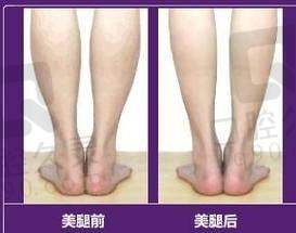 广州中家医家庭医生易普锋水动力小腿吸脂的术后护理