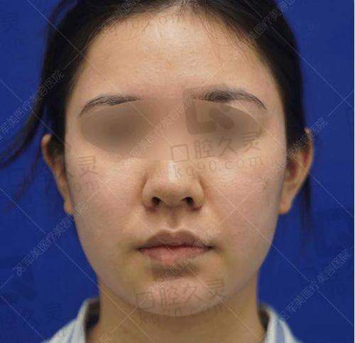广州中家医家庭医生易普锋面部吸脂2630元起——预约与询问