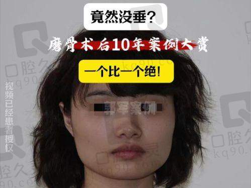 四、沈绍勇 7D 榫卯技术磨骨实例分享