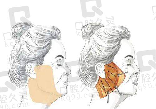 三点无痕术：轻中度衰老的理想解决方案