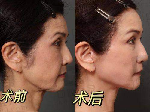 想面部提升？北京蒂凡妮王志坚，TCM年轻化与三点无痕术超牛