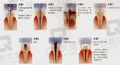 宁波牙博士口腔前磨牙显微根管治疗1500元起，精准保牙提升生活质量没商量
