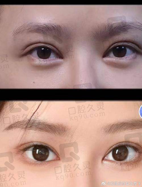 想修复失败双眼皮or眼角？来北京睐美安王恒医生看就对了！