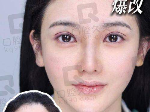北京睐美安王恒医生真实患者反馈：术后变化不是一点点！