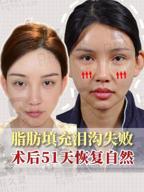 宋建星做脂肪填充修复技术有哪些独特优势？揭秘“术后自然柔软”的背后逻辑
