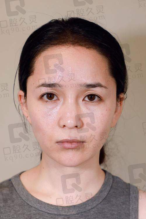 三、玻尿酸下巴修复各阶段护理要点