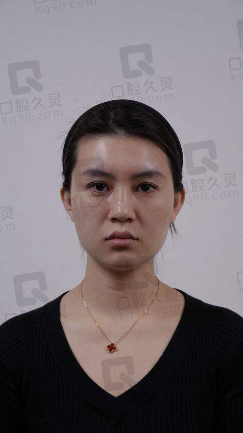 五、玻尿酸下巴修复相关常见问题解答