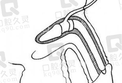 适合李世荣阴茎第二次延长术的群体有哪些？