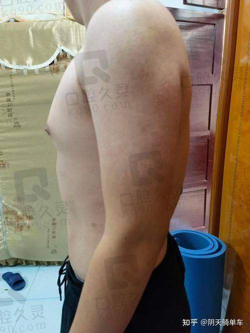 二次阴茎延长术操作难度更大，李世荣用专精和细节打动患者