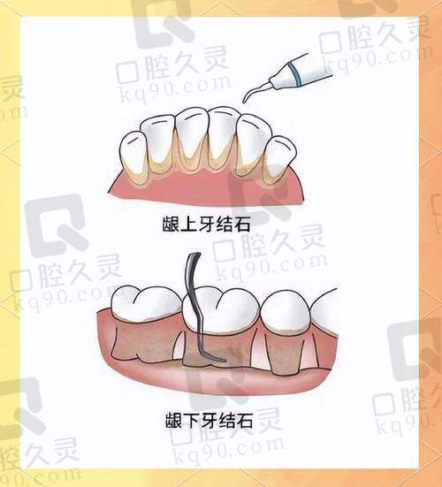 上海西郊众植口腔全口牙周炎治疗3千起有效固定松动牙，多样口腔服务伴您畅享健康美牙生活