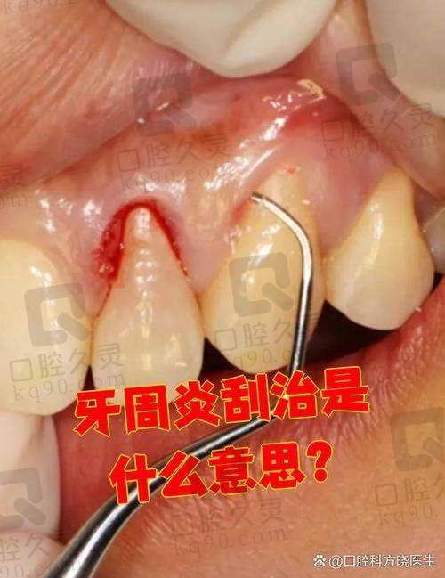 上海西郊众植口腔全口牙周炎治疗有什么成效呢？