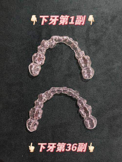 上海西郊众植口腔的隐适美隐形矫正技术有哪些特点？