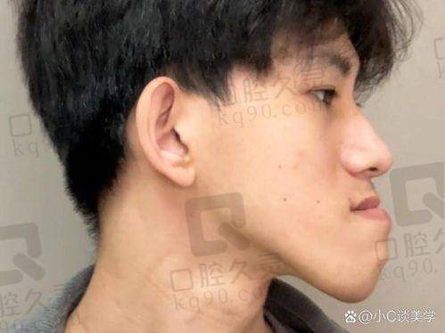 上海首尔丽格崔荣达医生地包天单颚矫正技术有哪些优势？