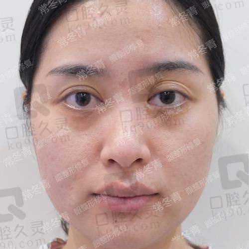 术后成效到底怎么样？真实实例曝光
