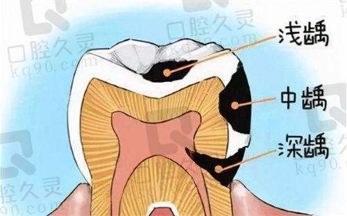 福州登特口腔医院补牙后的贴心叮嘱