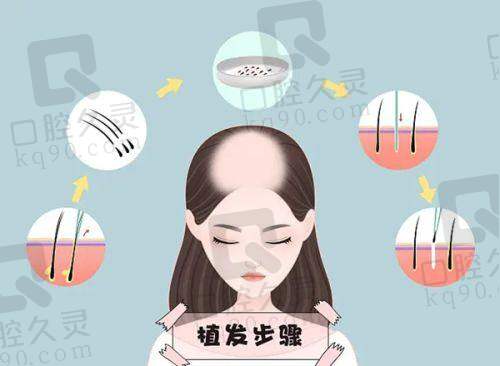 三、南通地区种植胡须项目收费情况