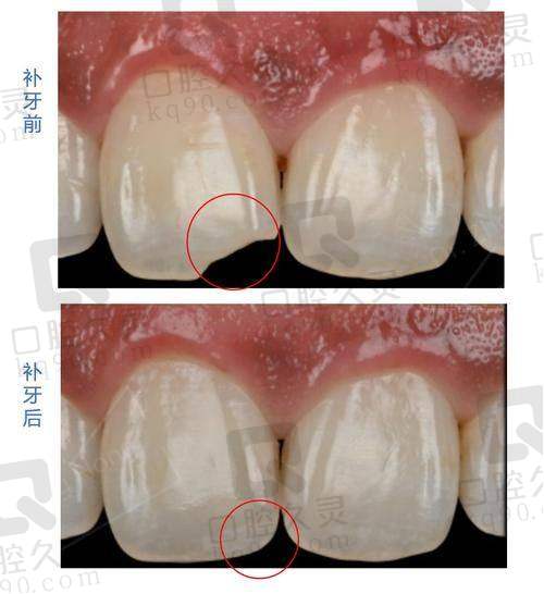 福州登特口腔医院补牙过程的安心体验
