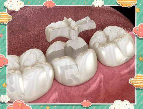 上海西郊众植口腔嵌体补牙采用了什么技术？