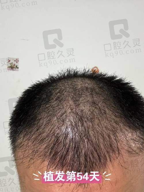 九、洛阳未毛植发诊所真实的患者评价