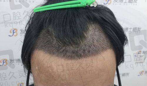 二、洛阳未毛植发诊所怎么样？