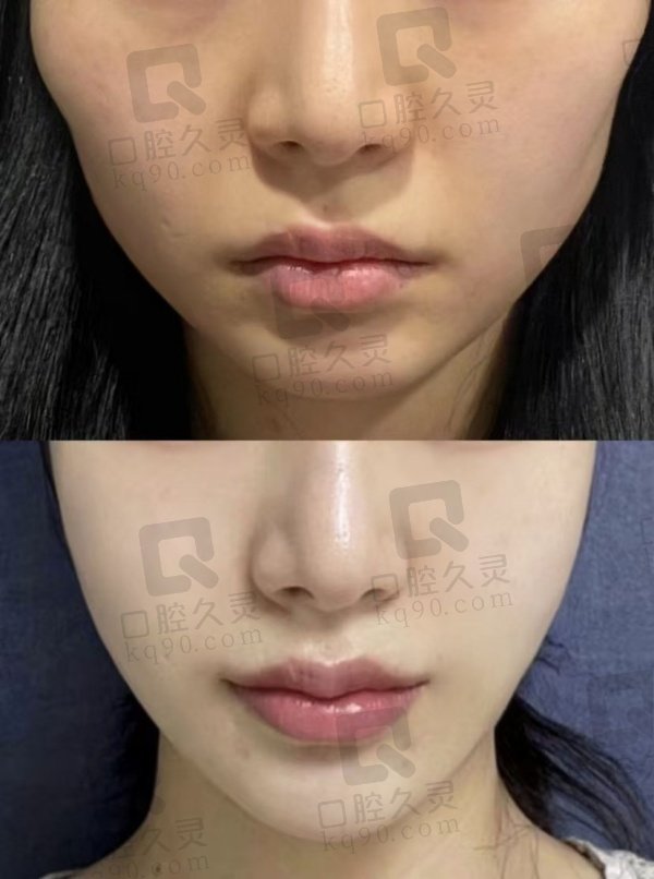重庆星荣整形外科医院V-LINE瓜子瘦脸手术4.5万起朱晓浩院长技术好，个性化方案助你安心变美