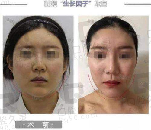 总结：牛永敢做鼻子多少钱的全方面分析