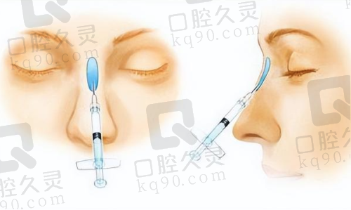 总结：综合考虑葡聚糖隆鼻的各项因素